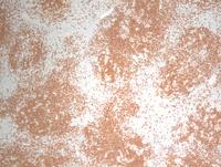 Classical Hodgkin lymphoma nodular lymphocyte rich subtype