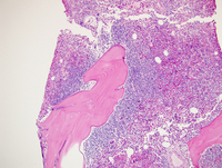 Follicular lymphoma involving the bone marrow 2