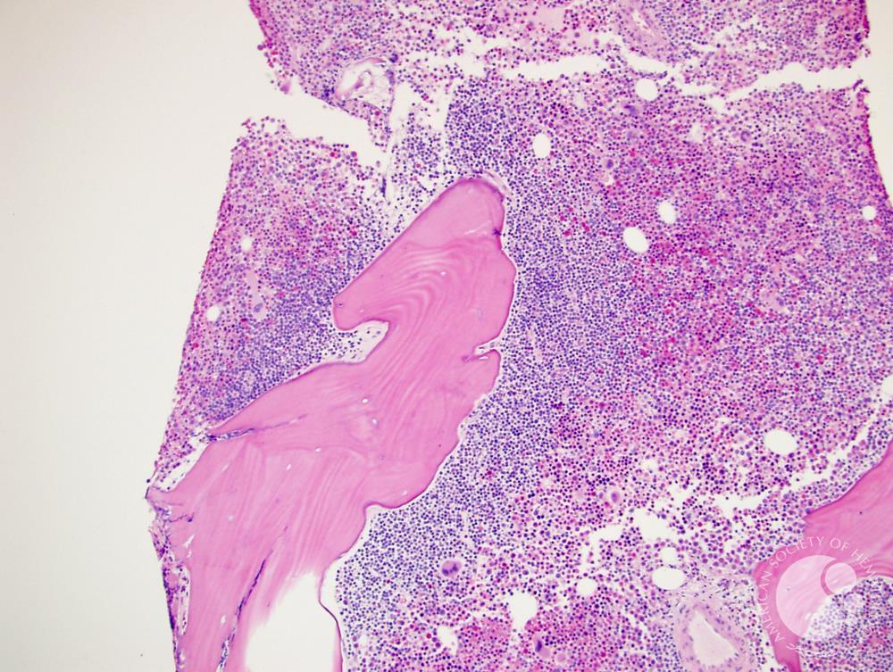 Follicular lymphoma involving the bone marrow 2