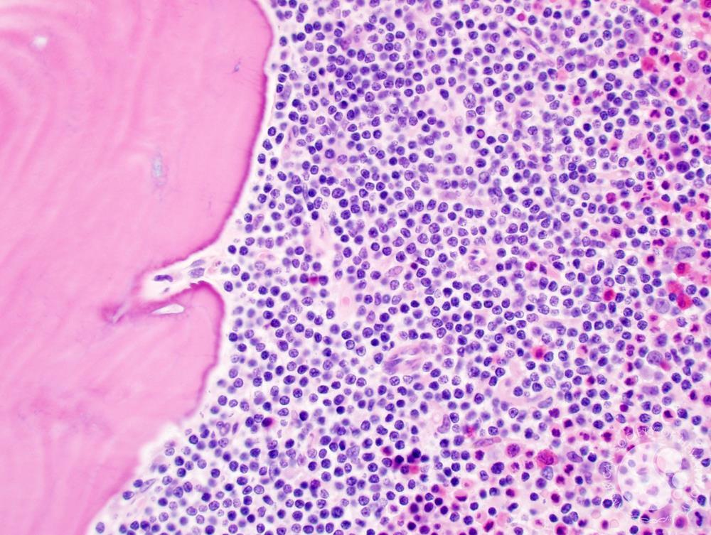 Follicular lymphoma involving the bone marrow 3