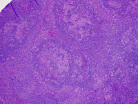 Nodular lymphocyte Predominant Hodgkin lymphoma 3