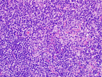 Nodular lymphocyte Predominant Hodgkin lymphoma 4