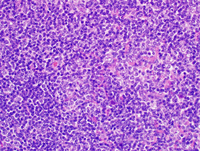 nodular lymphocyte predominant hodgkin lymphoma icd 10 code