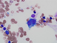 Refractory Cytopenia of Childhood