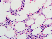 Refractory Cytopenia of Childhood