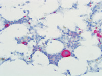 Refractory Cytopenia of Childhood