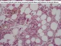 Refractory-cytopenia-of-childhood-GATA2-deficiency-related-Core-biopsy-reticulin-stain
