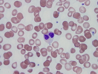 Refractory cytopenia of childhood, GATA2 deficiency related Peripheral blood