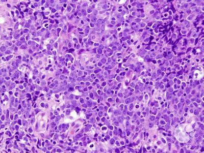 Diffuse large B-cell lymphoma, Leg type 1