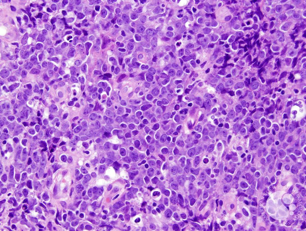 Diffuse large Bcell lymphoma, Leg type 1