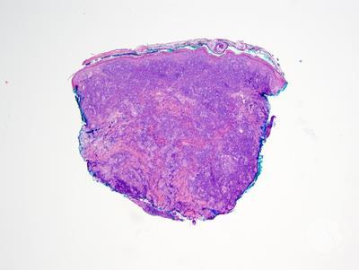Diffuse large B-cell lymphoma, Leg type 2