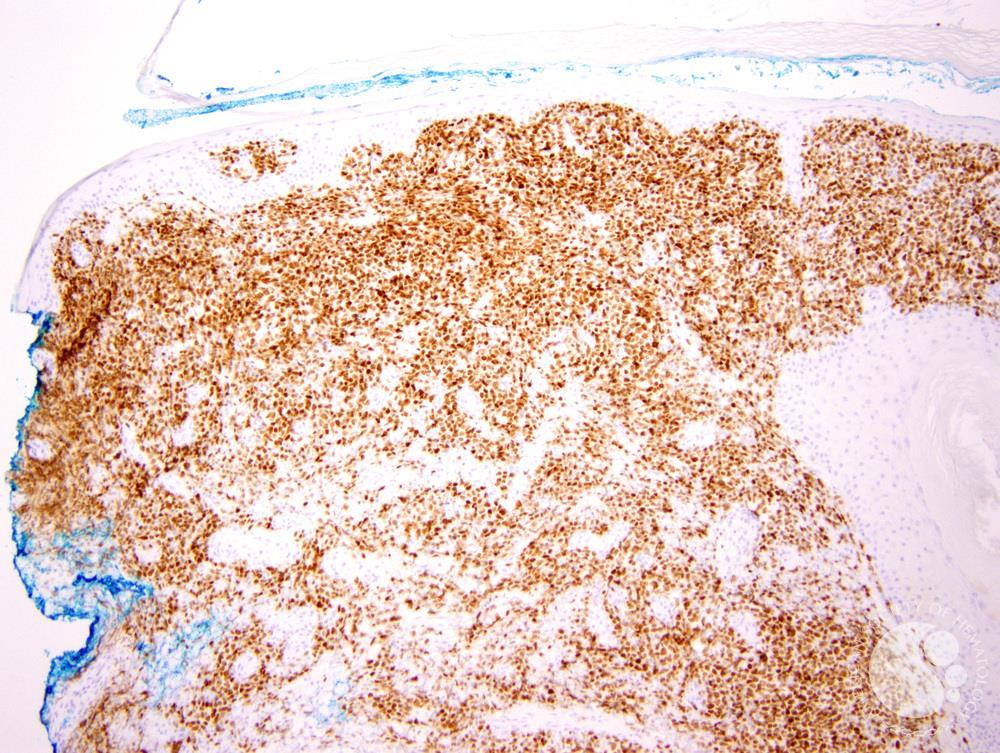 Diffuse large B-cell lymphoma, Leg type 5