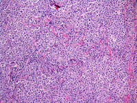 Follicular lymphoma, grade 3B 1