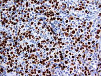 Follicular lymphoma, grade 3B 3