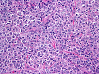 Follicular lymphoma grade 3b 9