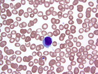 Hairy cell leukemia 2