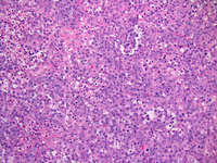 Anaplastic large cell lymphoma, ALK-positive 1