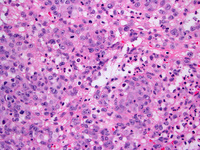 Anaplastic large cell lymphoma, ALK-positive 2