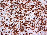 Anaplastic large cell lymphoma, ALK-positive 3