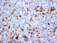 Anaplastic large cell lymphoma, ALK-positive 4