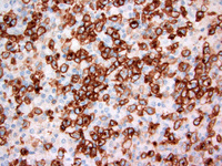 Anaplastic Large Cell Lymphoma Alk Positive 5