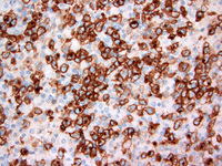 Anaplastic large cell lymphoma, ALK-positive 5