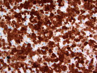 Anaplastic large cell lymphoma, ALK-positive 6