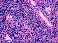 Extranodal NK/T-cell lymphoma 1