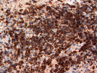 Extranodal NK/T-cell lymphoma 2