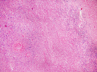 Extranodal NK/T-cell lymphoma 3