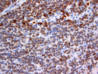 Extranodal NK/T-cell lymphoma 4