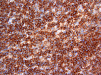 Extranodal NK/T-cell lymphoma 5