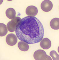 myeloblast vs promyelocyte