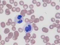 Neutrophils after ATRA/Arsenic therapy