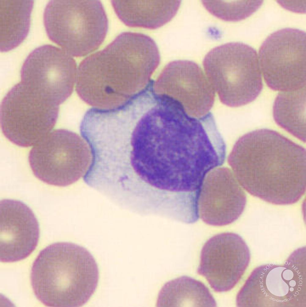 Reactive lymphocyte