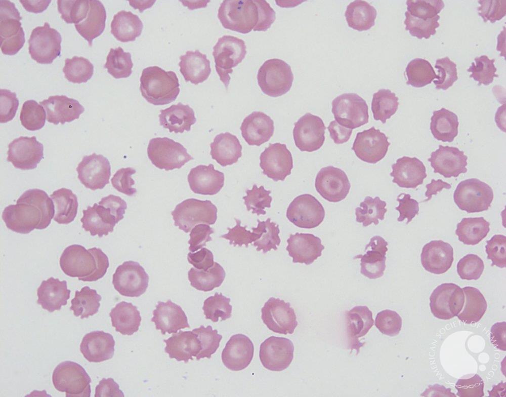 Acanthocyte