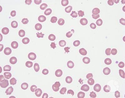 Acanthocyte