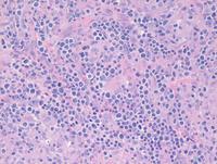 Lymphoepitheliod-cell-Lennerts-lymphoma