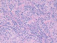 Lymphoepitheliod cell ("Lennert's") lymphoma