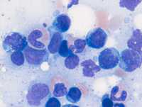 Adult T-cell leukemia/lymphoma 1