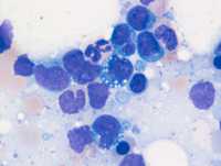 Flower cells of leukemia