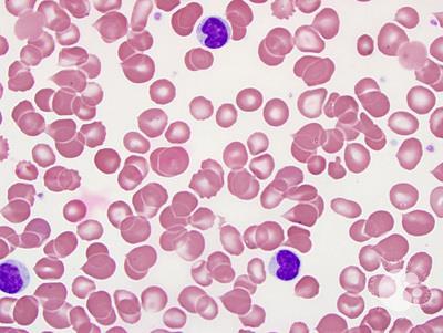Hepatosplenic T cell lymphoma 1