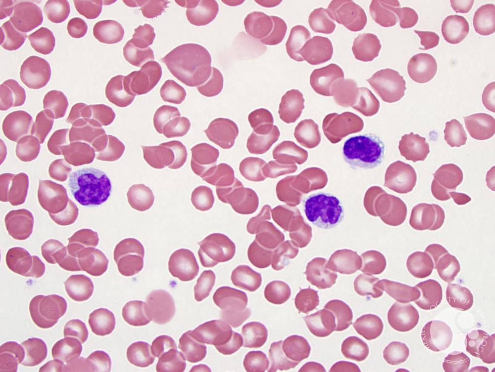 Hepatosplenic T cell lymphoma 2
