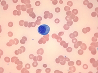 Plasma cell leukemia 1