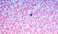 Plasma cell leukemia 3