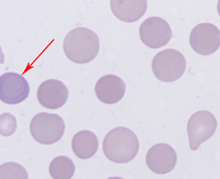 When to See a Hematologist for Anemia Cabot ring in hemolytic anemia 