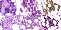 Morphologic and immunophenotypic transformation in plasma cell myeloma, mimicking acute lymphoblastic leukemia