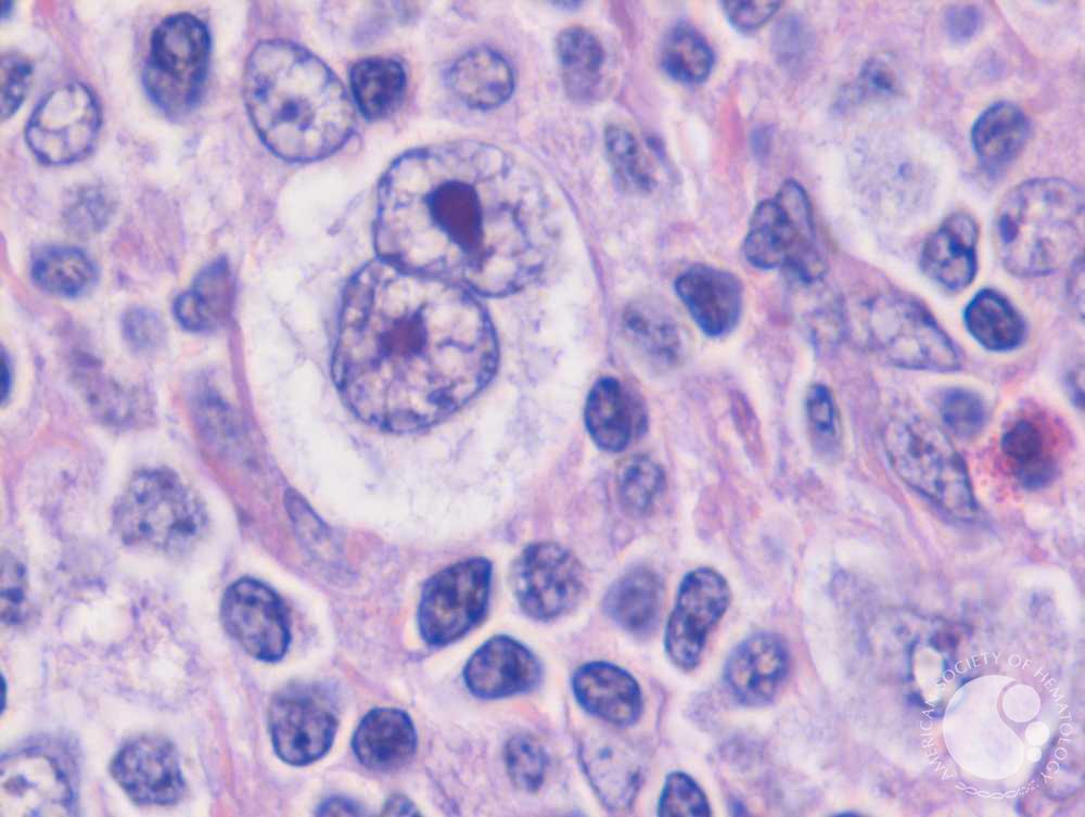 Reed Sternberg Cell