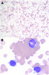 Infectious mononucleosis