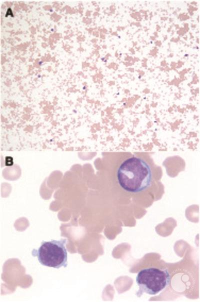 Red cell agglutination in infectious mononucleosis